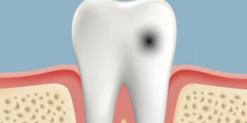 Зъбният кариес